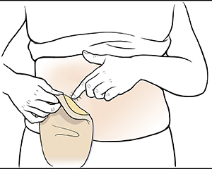 Female abdomen showing hands removing ostomy pouch.