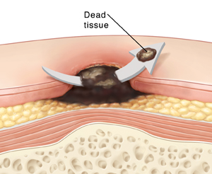 Cross section of skin showing pressure ulcer with scar material in center. Arrow is going through scar tissue showing part of tissue being removed.