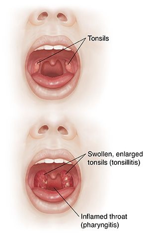 Front view of face with open mouth comparing normal oral cavity and tonsils with inflamed throat and enlarged tonsils.