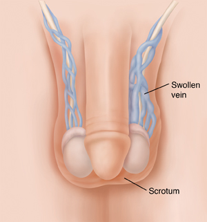 Front view of penis and testicles showing varicocele.