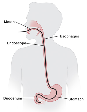Outline of child with head turned to side showing endoscope inserted into mouth, esophagus, stomach, and ending in duodenum.