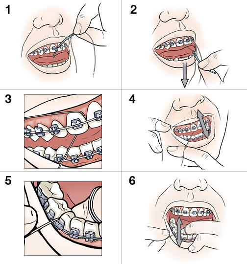 6 steps in flossing teeth and braces