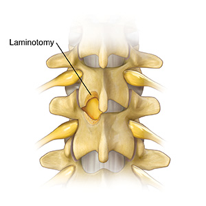 Back view of lumbar spine showing part of two vertebrae removed.