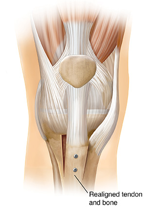 Front view of knee joint showing kneecap realignment.