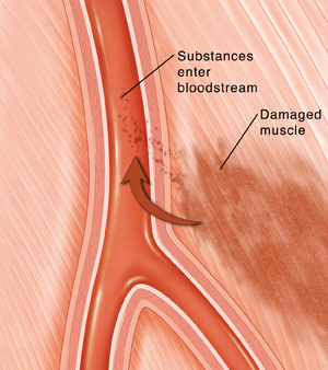 Cross section of artery in muscle. Muscle next to artery is damaged. Arrow shows substances from damage entering bloodstream through artery wall.