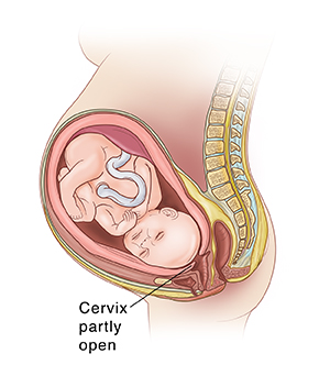 SIde view of fetus in uterus showing cervix beginning to thin and open in preterm labor.