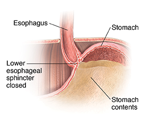 Closeup cross section of top part of stomach, lower esophagus, and diaphragm. Lower esophageal sphincter is closed, keeping stomach contents in stomach.