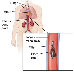 Cross section of inferior vena cava showing filter in place catching blood clot. Locator shows body outline with box to show location of filter in inferior vena cava.