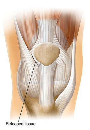 Front view of knee joint showing showing lateral retinacular release.
