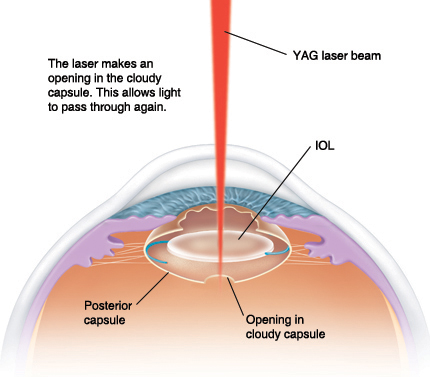 Cross section side view of eye showing YAG laser beam entering clear cornea and through pupil to IOL in cloudy posterior capsule. Laser makes opening in cloudy capsule to allow light to pass through again.