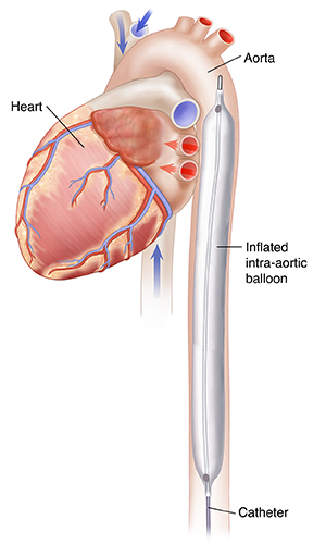 Side view of heart during diastole showing inflated intra-aortic balloon pump in aorta.