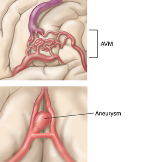 Closeup view of arteriovenous malformation (AVM) in the brain. Closeup view of aneurysm in the brain.