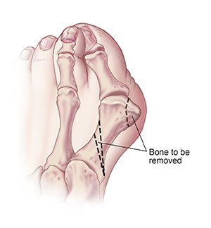 Top view of big toe with dotted line showing areas of bone to be removed for bunion base osteotomy.