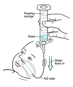 Hand holding syringe filled with water attached to infant's nasogastric tube. Water flowing from syringe into tube.