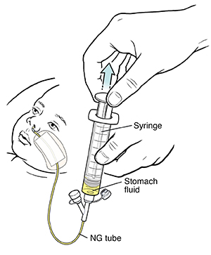 Hand pulling up plunger on syringe attached to infant's nasogastric tube. Fluid beginning to fill syringe.