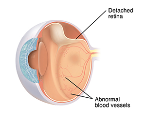 Cross section three-quarter view of eye showing retinopathy of prematurity. 