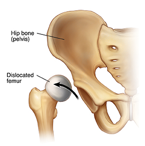 Front view of hip bone showing dislocated femur with head of femur coming out of socket.