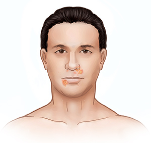 Front view of man's face showing impetigo around nose and mouth.