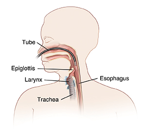 Outline of woman showing endoscope inserted through nose into throat just above epiglottis.