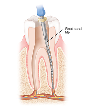 Cross section of tooth showing file inserted into root canal. 