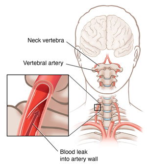 Front view of male outline showing the vertebral arteries and a blow up of a vertebral artery dissection. 
