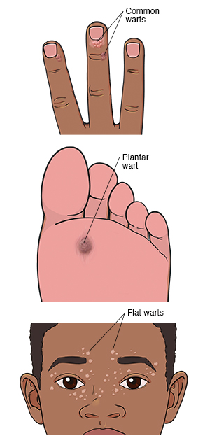 Common wart on end of finger. Plantar wart on sole of foot. Flat warts on face.