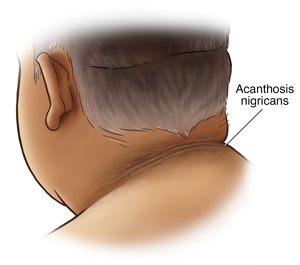 The back of a man's neck showing acanthosis nigricans.