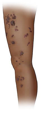 Side view of a leg with a patchy rash from thigh to calf.