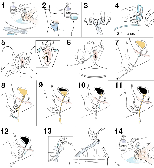 14 steps to inserting a disposable urinary catheter