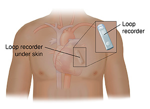 Front view of person's chest showing the heart and a loop recorder under the skin above the heart. An inset shows the loop recorder close up.