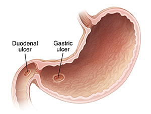 Cross section of stomach showing gastric and duodenal ulcers.