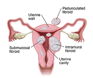 Front view cross section of uterus showing three types of fibroids.