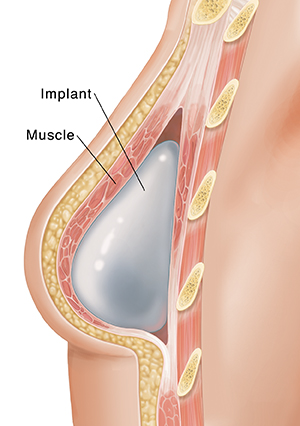 Cross section of breast showing implant after mastectomy.