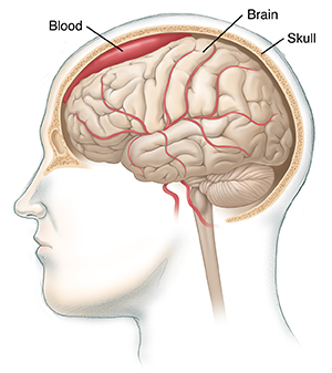 Side view of head with cross section of skull showing whole brain with blood between brain and skull.
