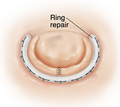 Top view of heart valve with C-shaped ring sutured around valve for repair.