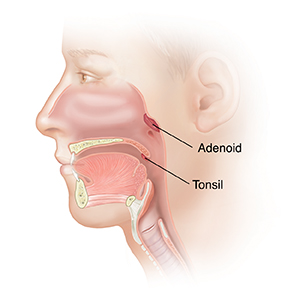 Side view of head showing adenoid and tonsil.