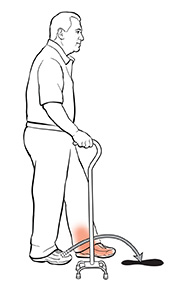 Man using quad cane, showing all four tips down and stepping forward with cane and affected leg.. The arrow shows where he should put his foot.