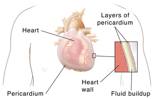 Front view of male chest showing heart with inset showing pericardial effusion.