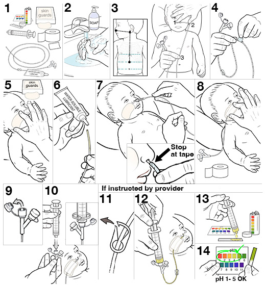14 steps for placing an NG tube for your baby