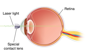 Side view of eye showing lens on front of eye. Laser light is focusing on inside back wall of eye.