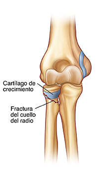 Vista frontal de una articulación de codo en donde se muestran una fractura del cuello radial.